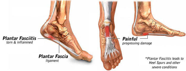 plantar-fascia